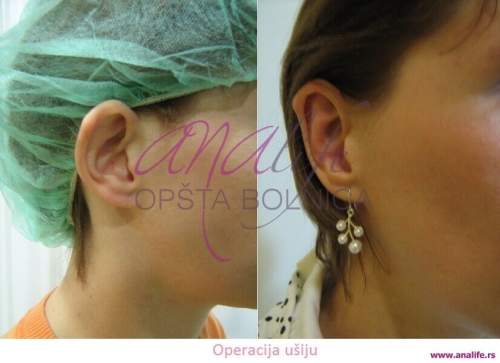 Operacija ušiju (otoplastika) – korekcija klempavih ušiju i prirodan oblik ušne školjke - slika 5