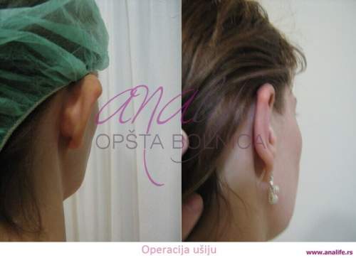 Operacija ušiju (otoplastika) – korekcija klempavih ušiju i prirodan oblik ušne školjke - slika 8