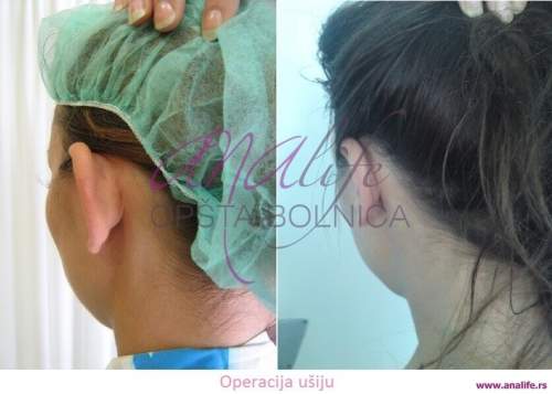 Operacija ušiju (otoplastika) – korekcija klempavih ušiju i prirodan oblik ušne školjke - slika 9