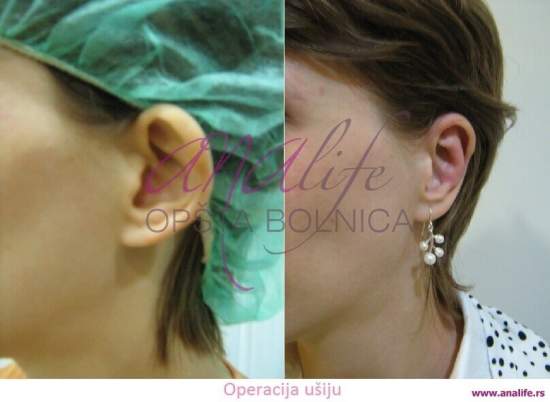 Operacija ušiju (otoplastika) – korekcija klempavih ušiju i prirodan oblik ušne školjke - slika 12