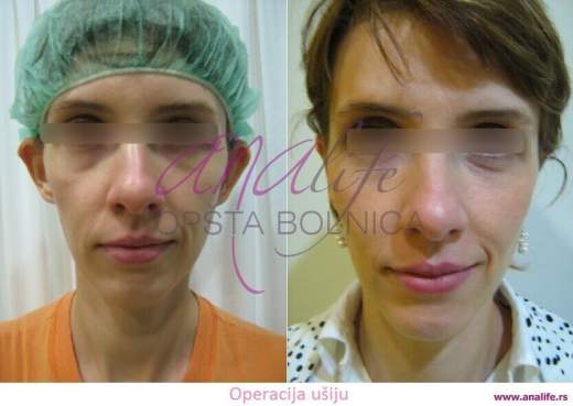 Operacija ušiju (otoplastika) – korekcija klempavih ušiju i prirodan oblik ušne školjke - slika 14