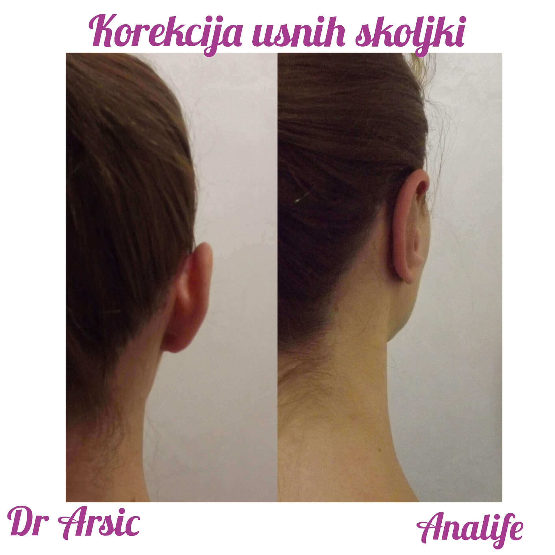 Operacija ušiju (otoplastika) – korekcija klempavih ušiju i prirodan oblik ušne školjke - slika 25
