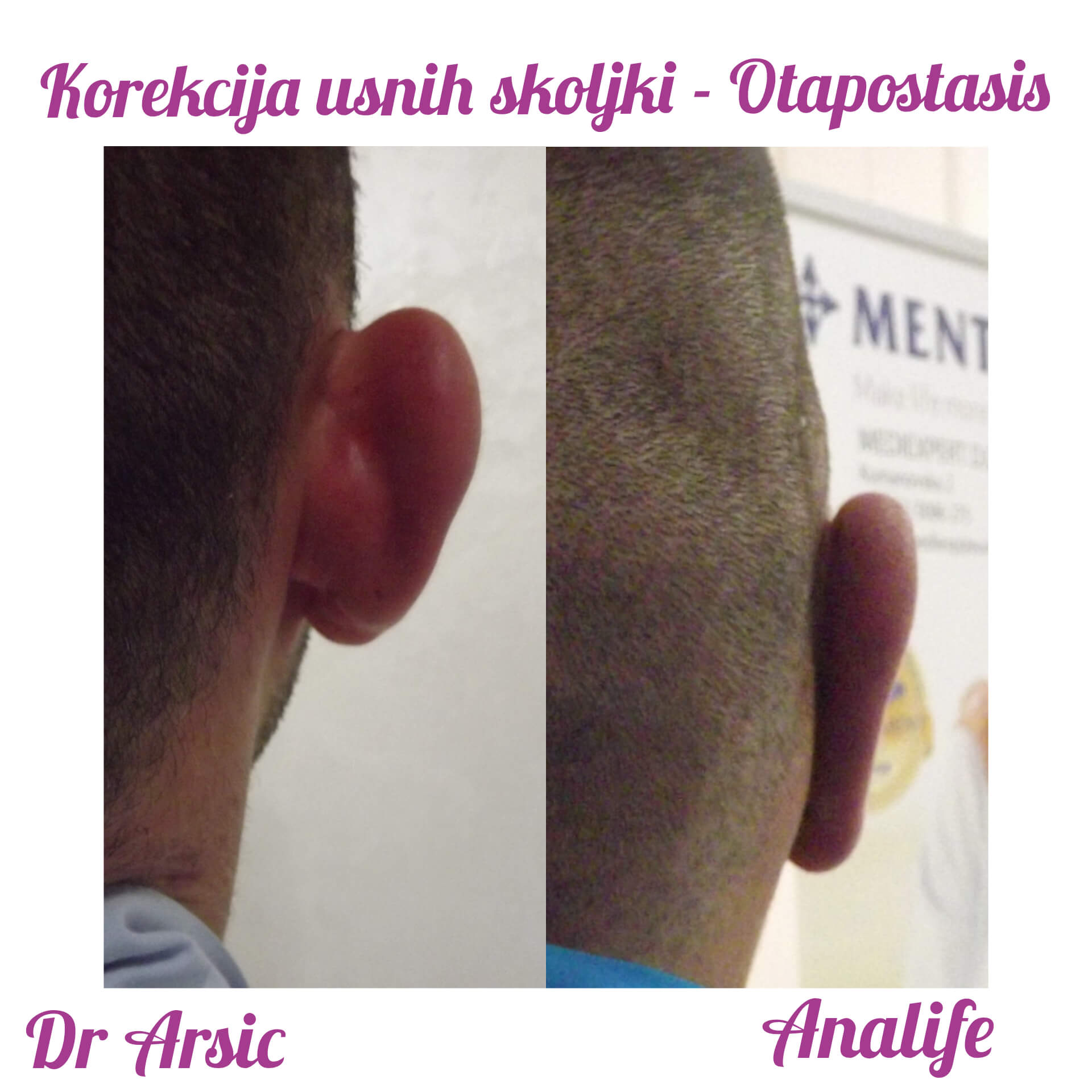 Operacija ušiju (otoplastika) – korekcija klempavih ušiju i prirodan oblik ušne školjke - slika 29