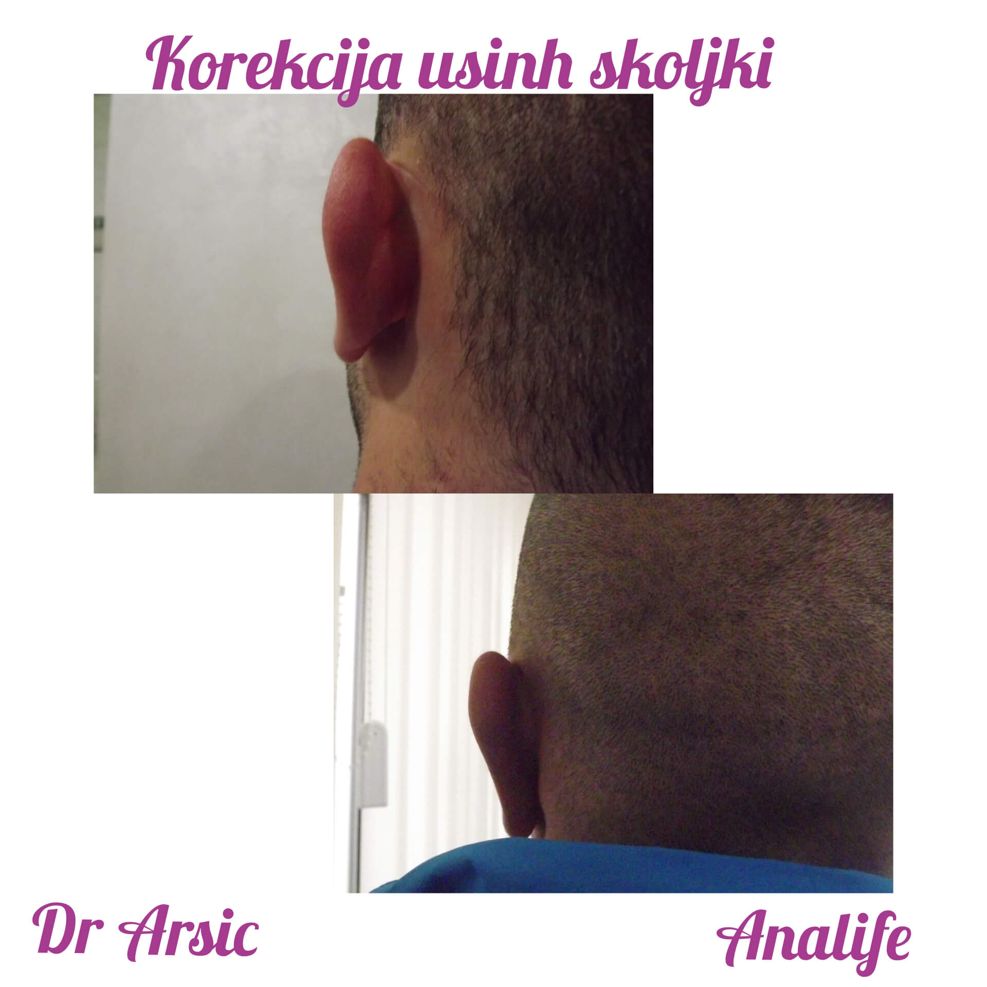 Operacija ušiju (otoplastika) – korekcija klempavih ušiju i prirodan oblik ušne školjke - slika 30