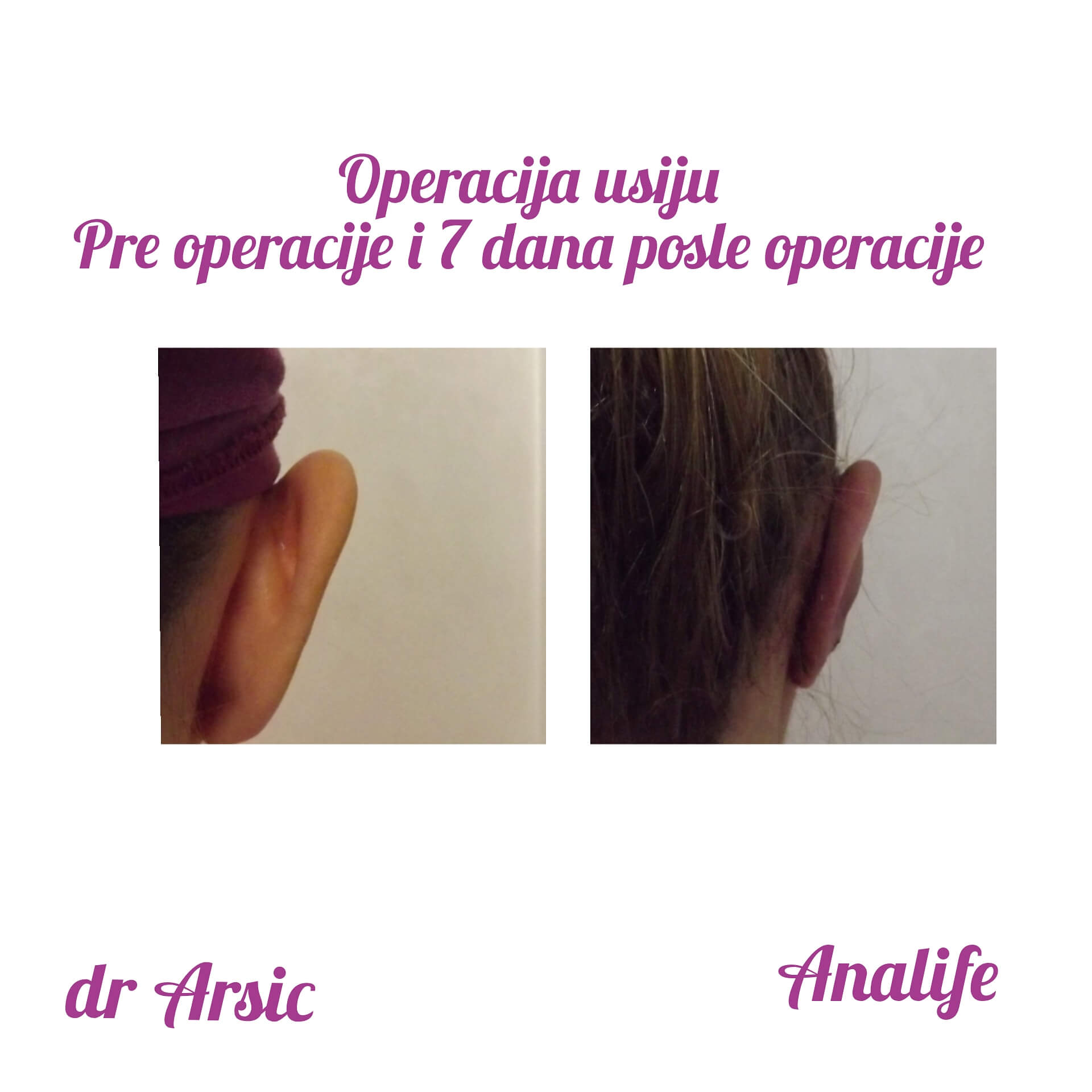 Operacija ušiju (otoplastika) – korekcija klempavih ušiju i prirodan oblik ušne školjke - slika 31