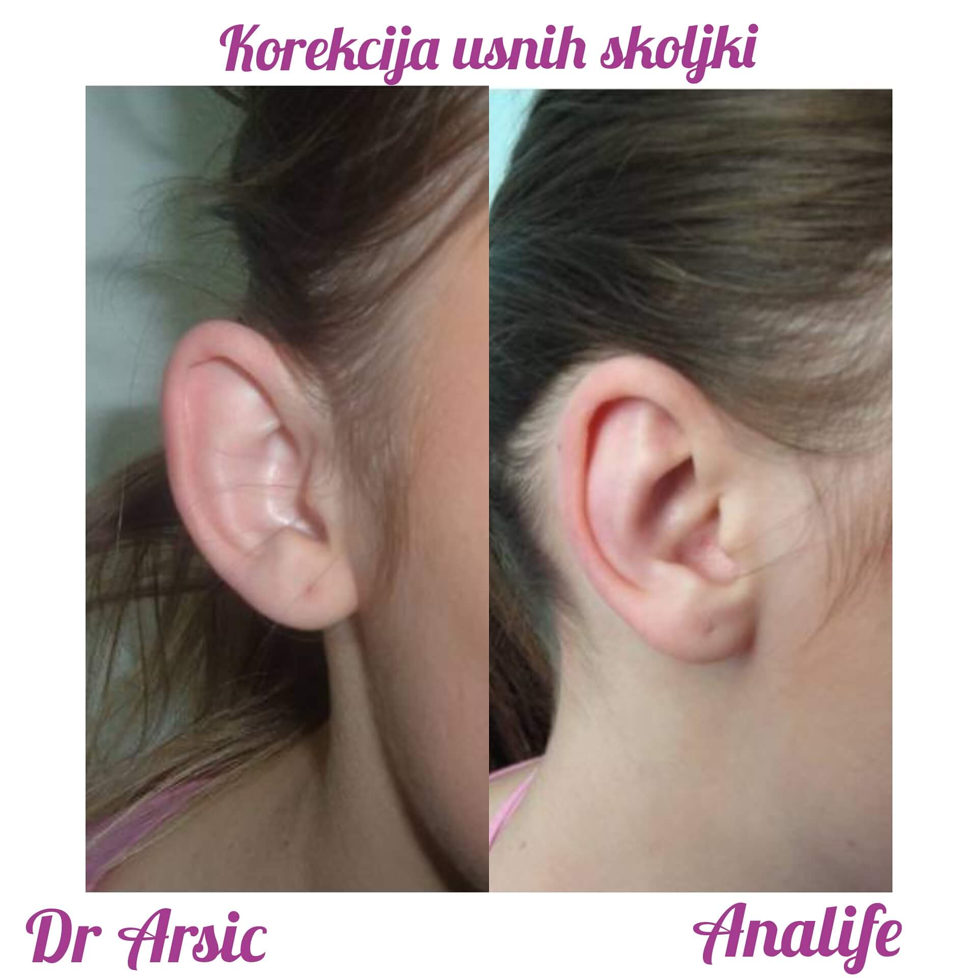 Operacija ušiju (otoplastika) – korekcija klempavih ušiju i prirodan oblik ušne školjke - slika 32