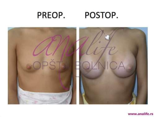 Povećanje grudi (augmentacija) – prirodan volumen i sklad proporcija - slika 2
