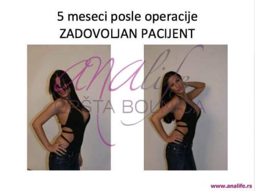 Povećanje grudi (augmentacija) – prirodan volumen i sklad proporcija - slika 3