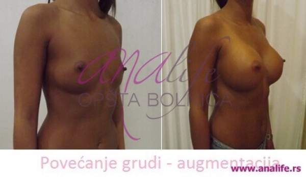Povećanje grudi (augmentacija) – prirodan volumen i sklad proporcija - slika 7