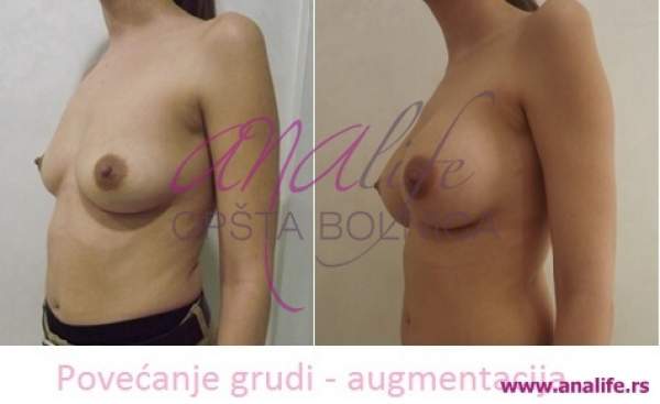 Povećanje grudi (augmentacija) – prirodan volumen i sklad proporcija - slika 8