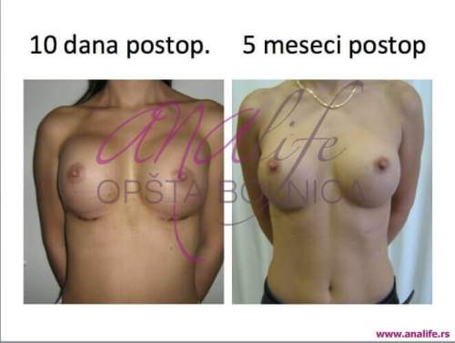 Povećanje grudi (augmentacija) – prirodan volumen i sklad proporcija - slika 9