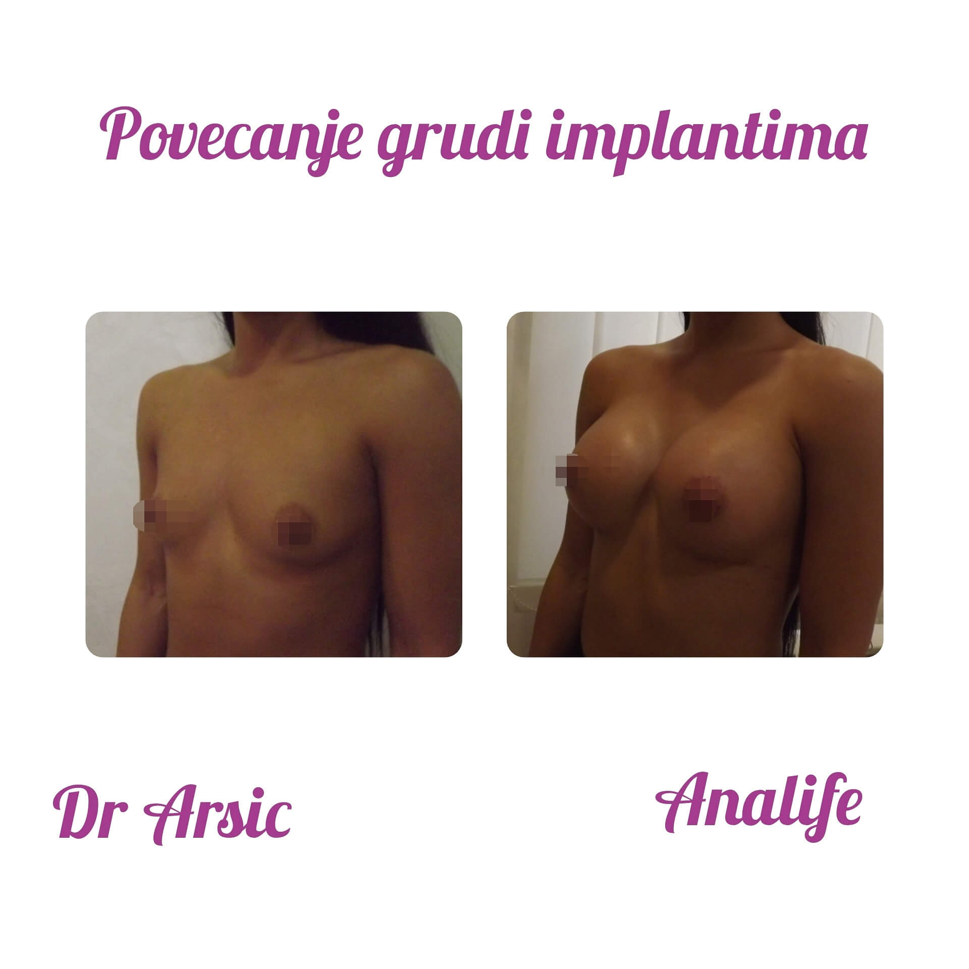 Povećanje grudi (augmentacija) – prirodan volumen i sklad proporcija - slika 104