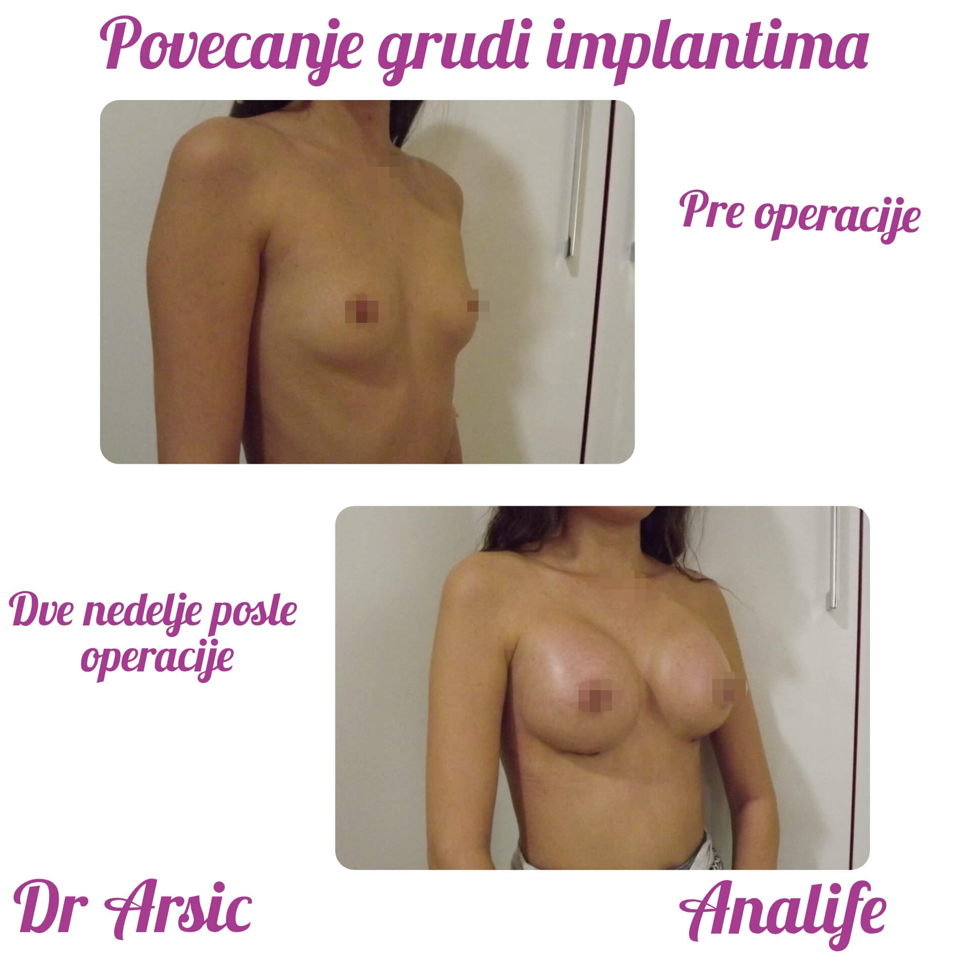 Povećanje grudi (augmentacija) – prirodan volumen i sklad proporcija - slika 106