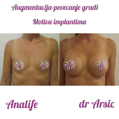 Povećanje grudi (augmentacija) – prirodan volumen i sklad proporcija - slika 11