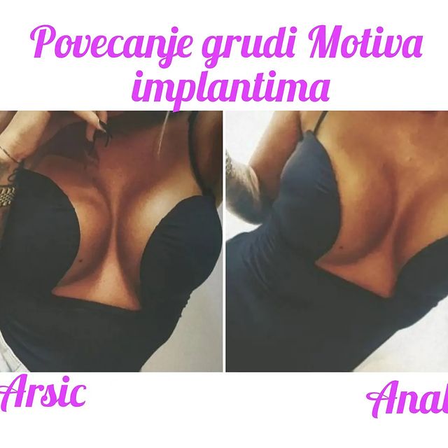 Povećanje grudi (augmentacija) – prirodan volumen i sklad proporcija - slika 114
