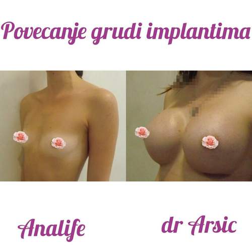 Povećanje grudi (augmentacija) – prirodan volumen i sklad proporcija - slika 14