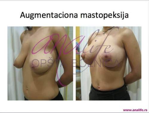 Povećanje grudi (augmentacija) – prirodan volumen i sklad proporcija - slika 15