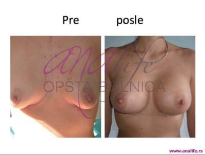 Povećanje grudi (augmentacija) – prirodan volumen i sklad proporcija - slika 19