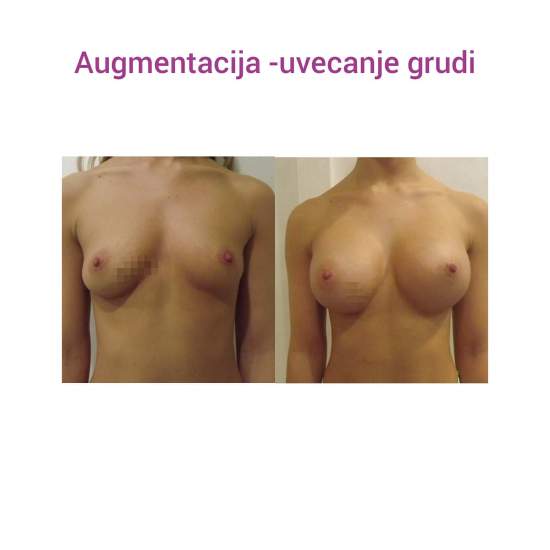 Povećanje grudi (augmentacija) – prirodan volumen i sklad proporcija - slika 20