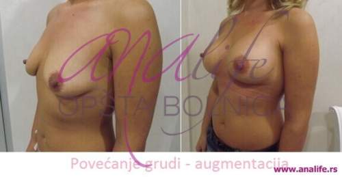 Povećanje grudi (augmentacija) – prirodan volumen i sklad proporcija - slika 24