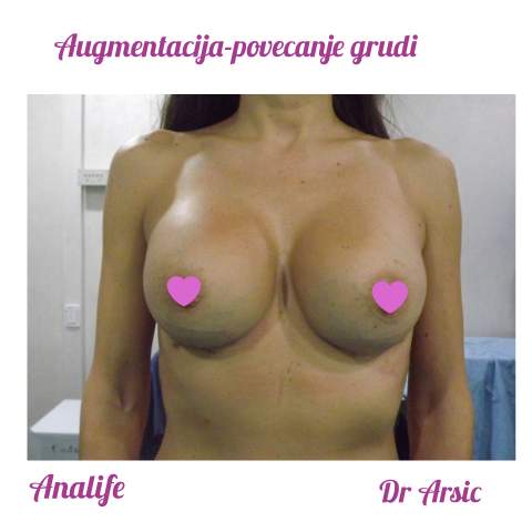 Povećanje grudi (augmentacija) – prirodan volumen i sklad proporcija - slika 32