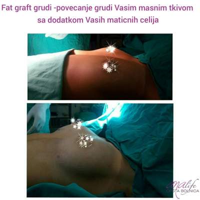 Povećanje grudi (augmentacija) – prirodan volumen i sklad proporcija - slika 34