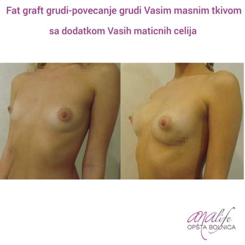 Povećanje grudi (augmentacija) – prirodan volumen i sklad proporcija - slika 35