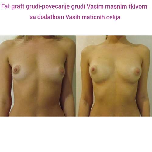 Povećanje grudi (augmentacija) – prirodan volumen i sklad proporcija - slika 36