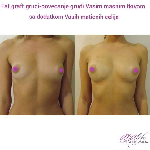 Povećanje grudi (augmentacija) – prirodan volumen i sklad proporcija - slika 37
