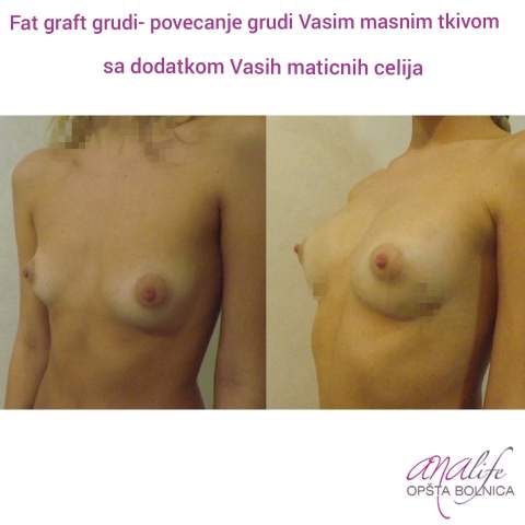 Povećanje grudi (augmentacija) – prirodan volumen i sklad proporcija - slika 38