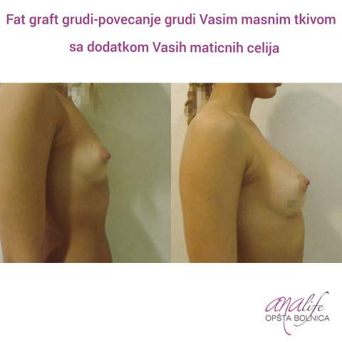 Povećanje grudi (augmentacija) – prirodan volumen i sklad proporcija - slika 39