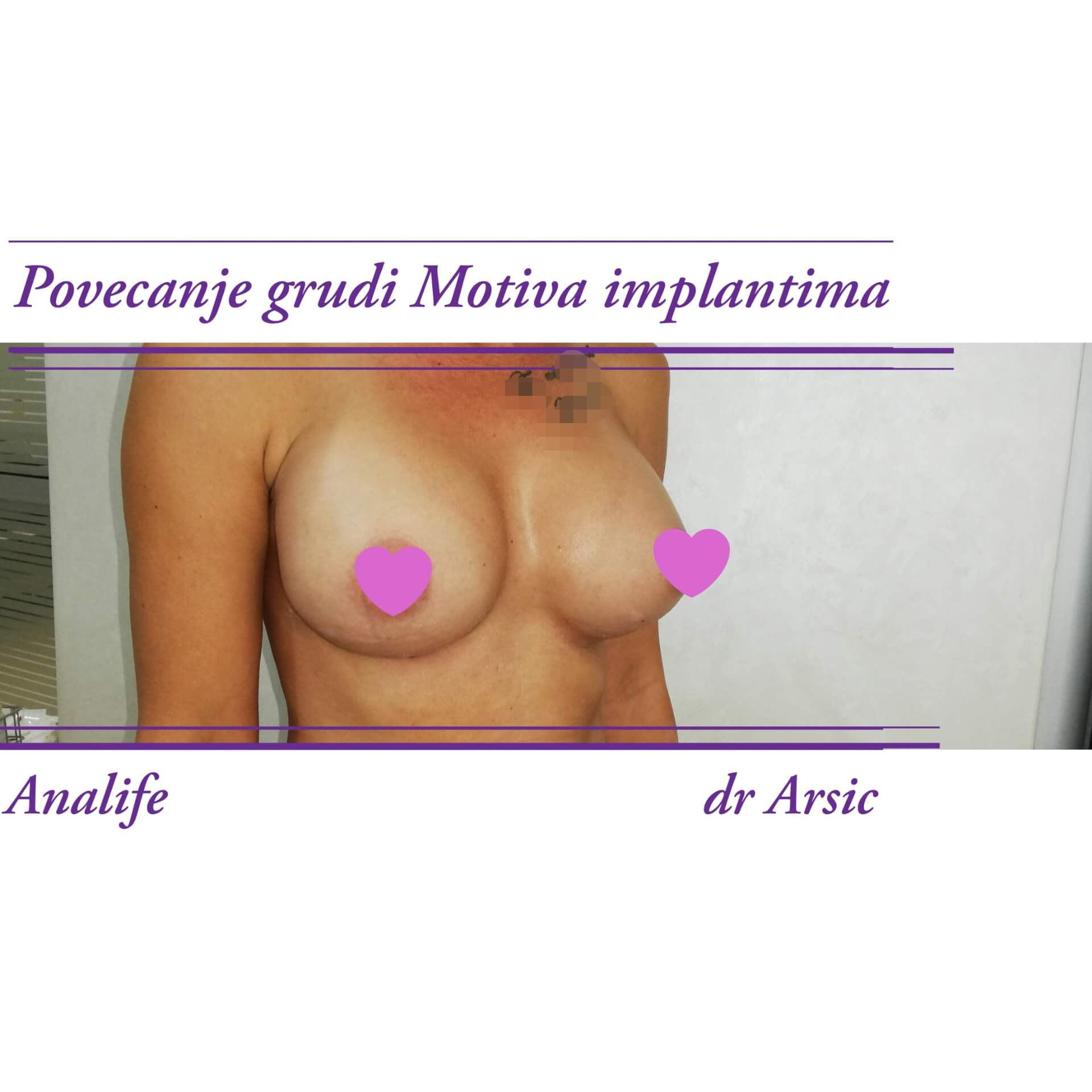 Povećanje grudi (augmentacija) – prirodan volumen i sklad proporcija - slika 43