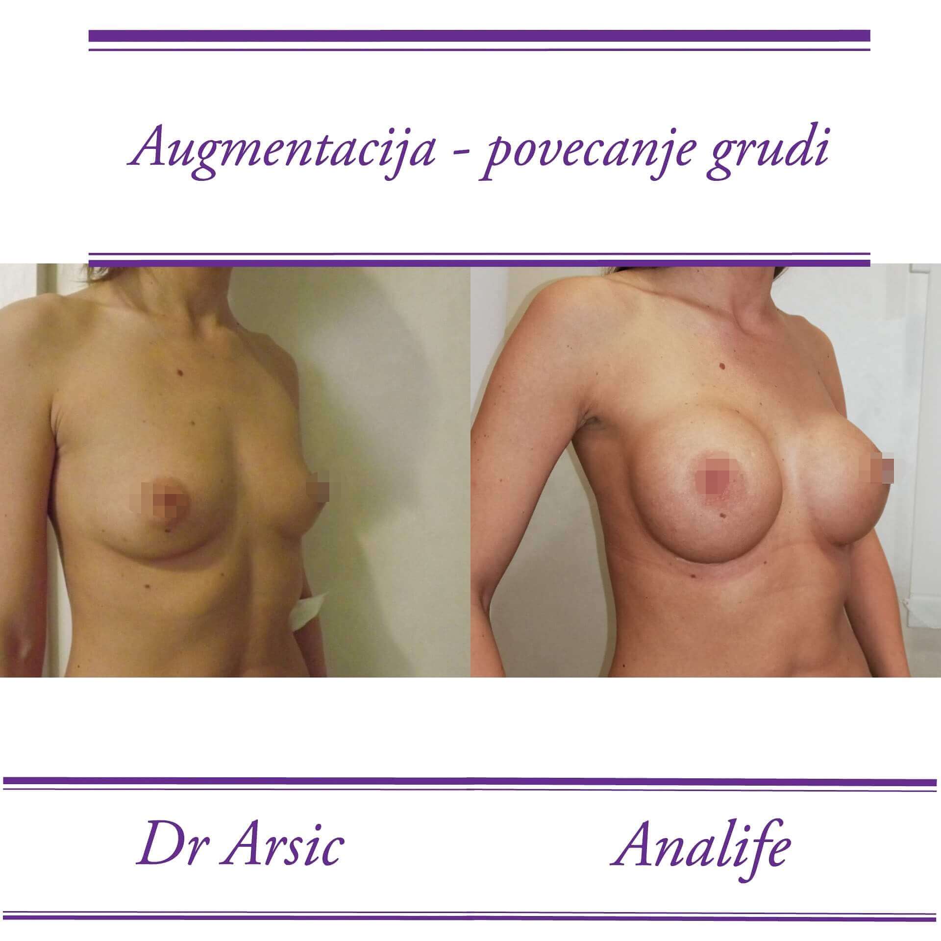 Povećanje grudi (augmentacija) – prirodan volumen i sklad proporcija - slika 45
