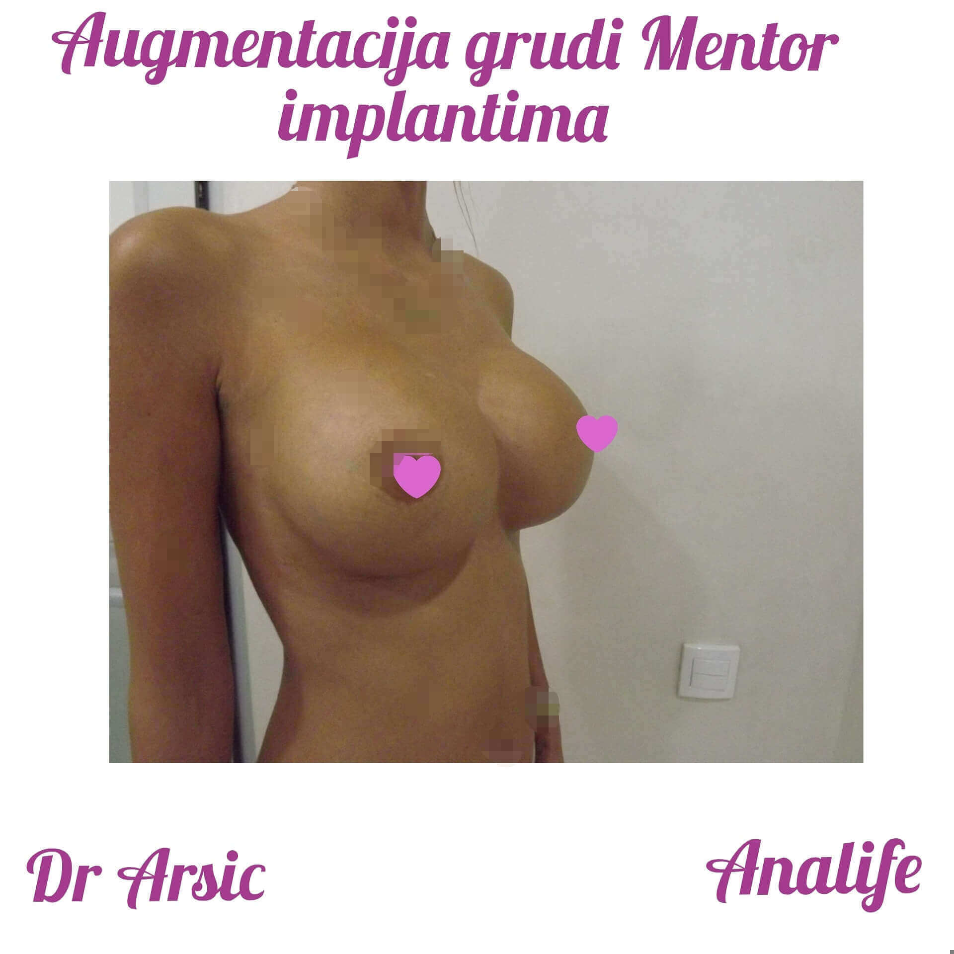 Povećanje grudi (augmentacija) – prirodan volumen i sklad proporcija - slika 48
