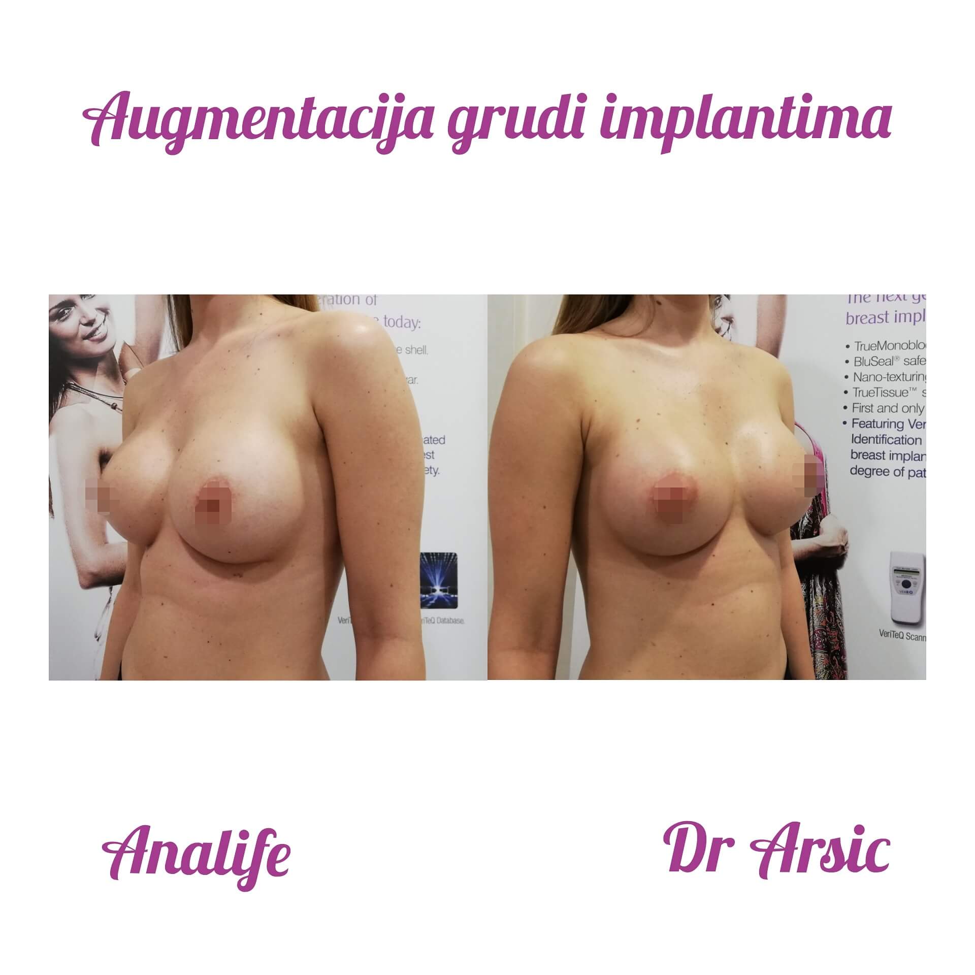 Povećanje grudi (augmentacija) – prirodan volumen i sklad proporcija - slika 50