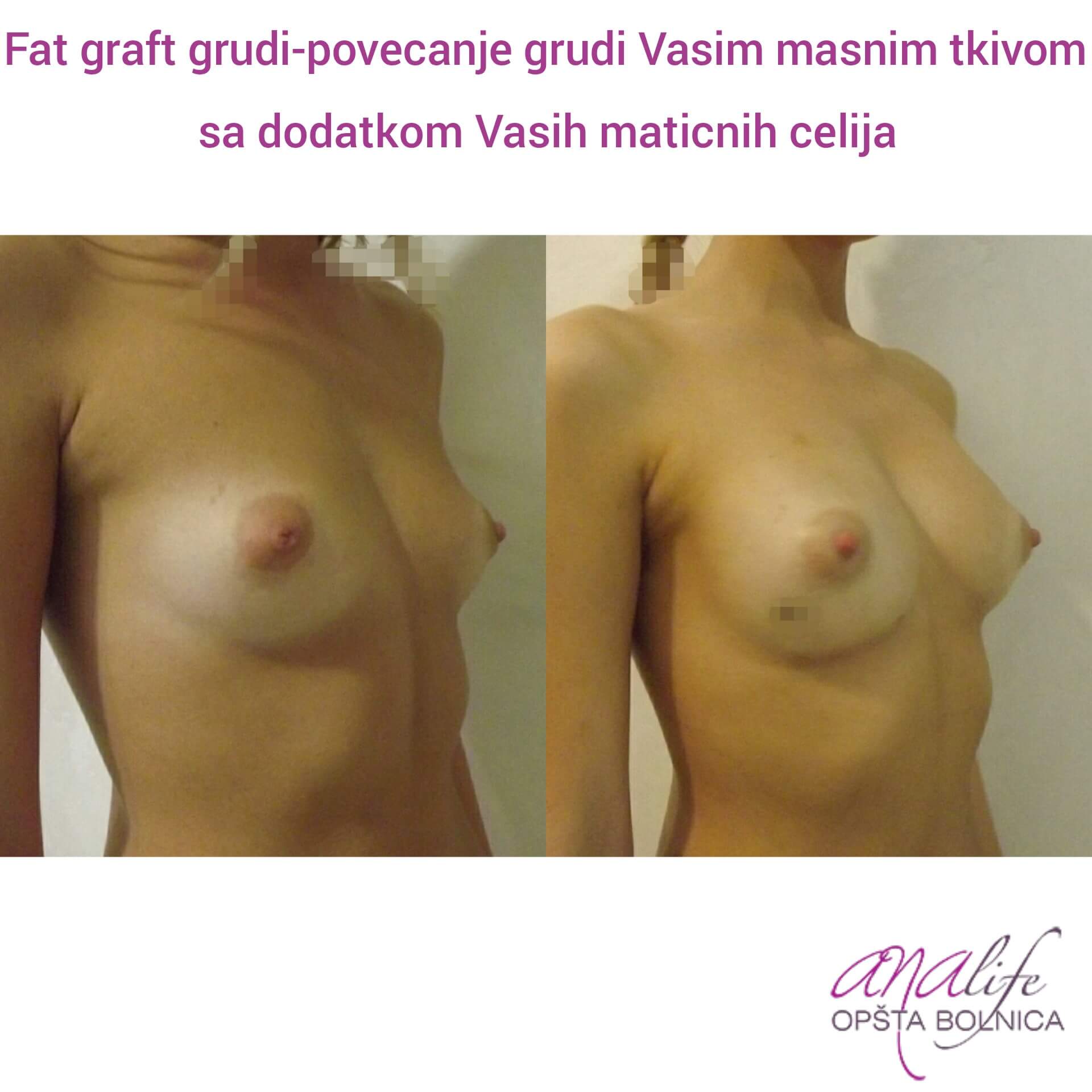 Povećanje grudi (augmentacija) – prirodan volumen i sklad proporcija - slika 51