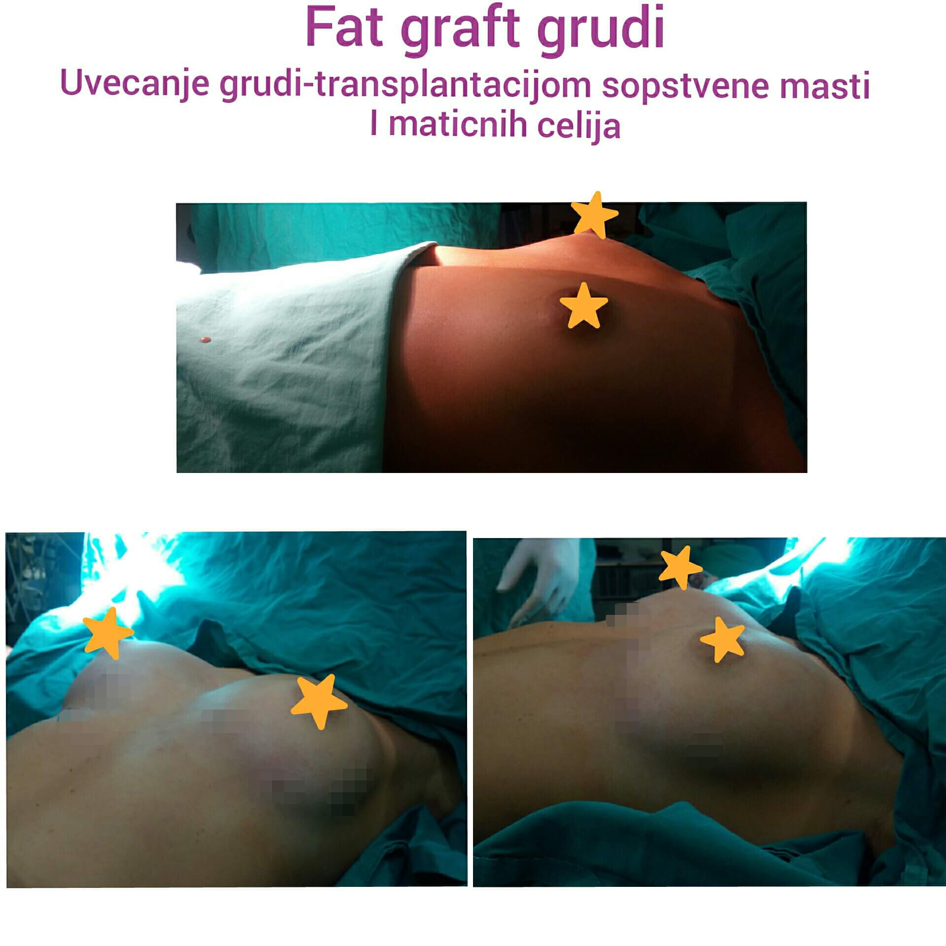Povećanje grudi (augmentacija) – prirodan volumen i sklad proporcija - slika 53