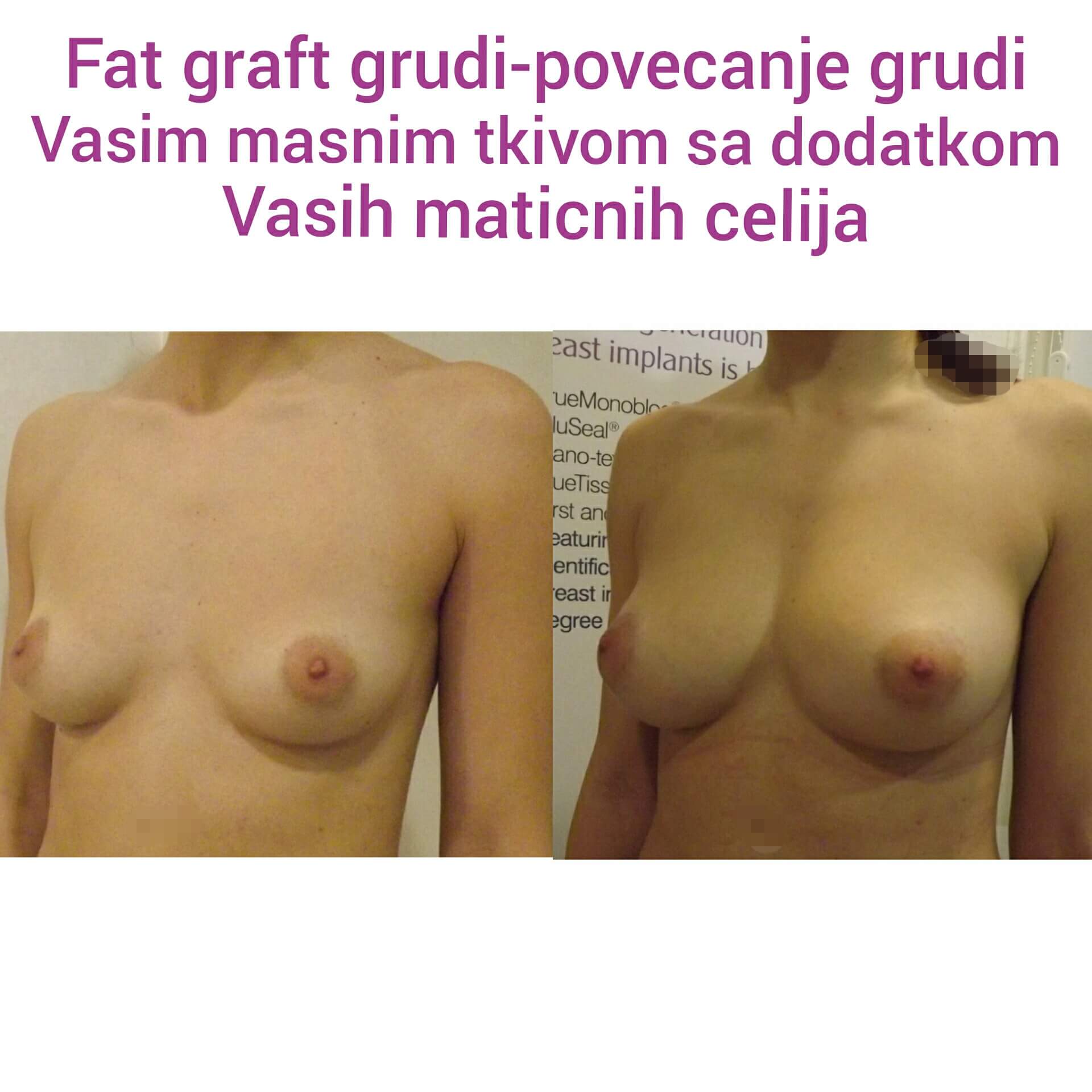 Povećanje grudi (augmentacija) – prirodan volumen i sklad proporcija - slika 54