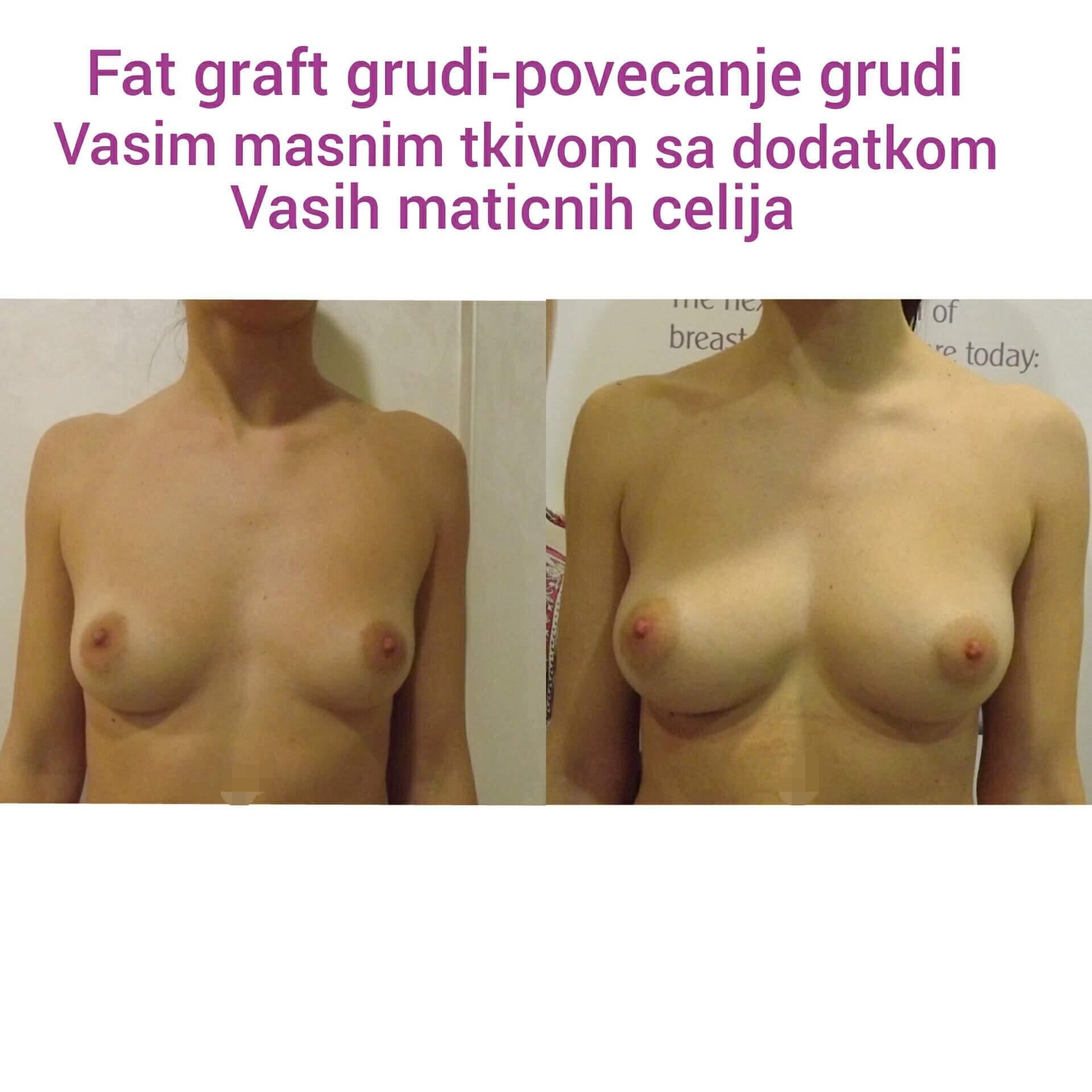 Povećanje grudi (augmentacija) – prirodan volumen i sklad proporcija - slika 55