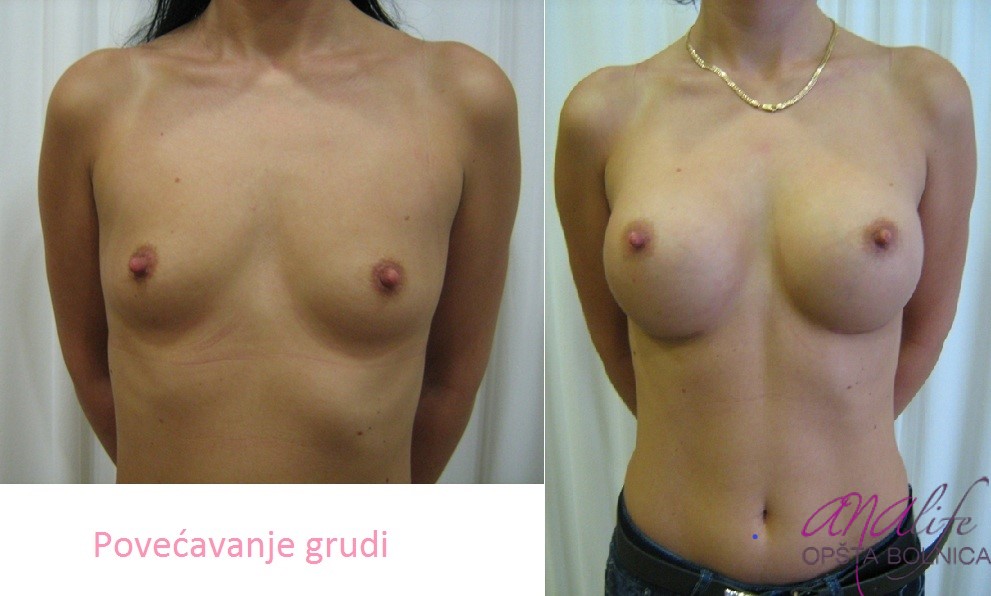 Povećanje grudi (augmentacija) – prirodan volumen i sklad proporcija - slika 60