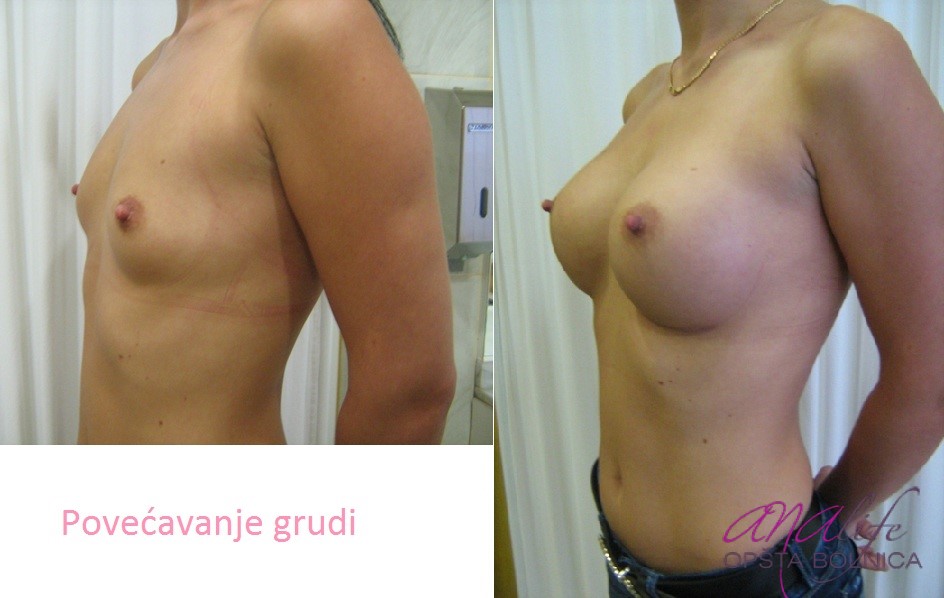 Povećanje grudi (augmentacija) – prirodan volumen i sklad proporcija - slika 63