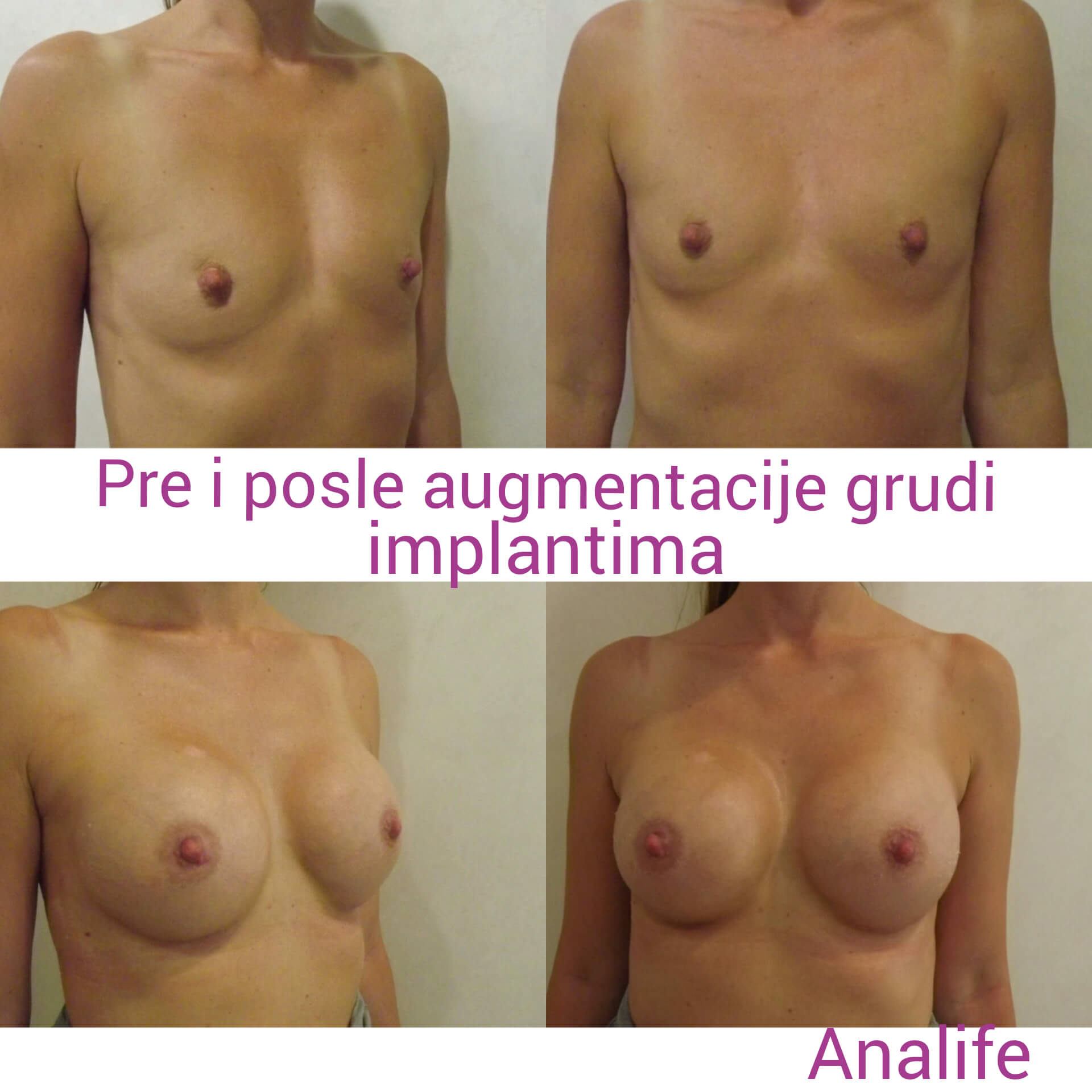 Povećanje grudi (augmentacija) – prirodan volumen i sklad proporcija - slika 64