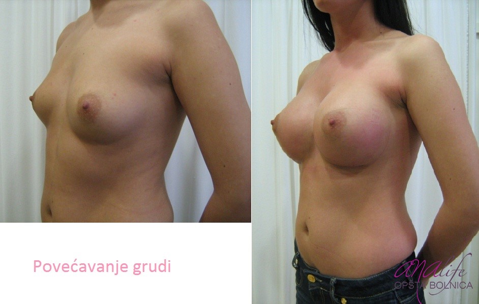 Povećanje grudi (augmentacija) – prirodan volumen i sklad proporcija - slika 67