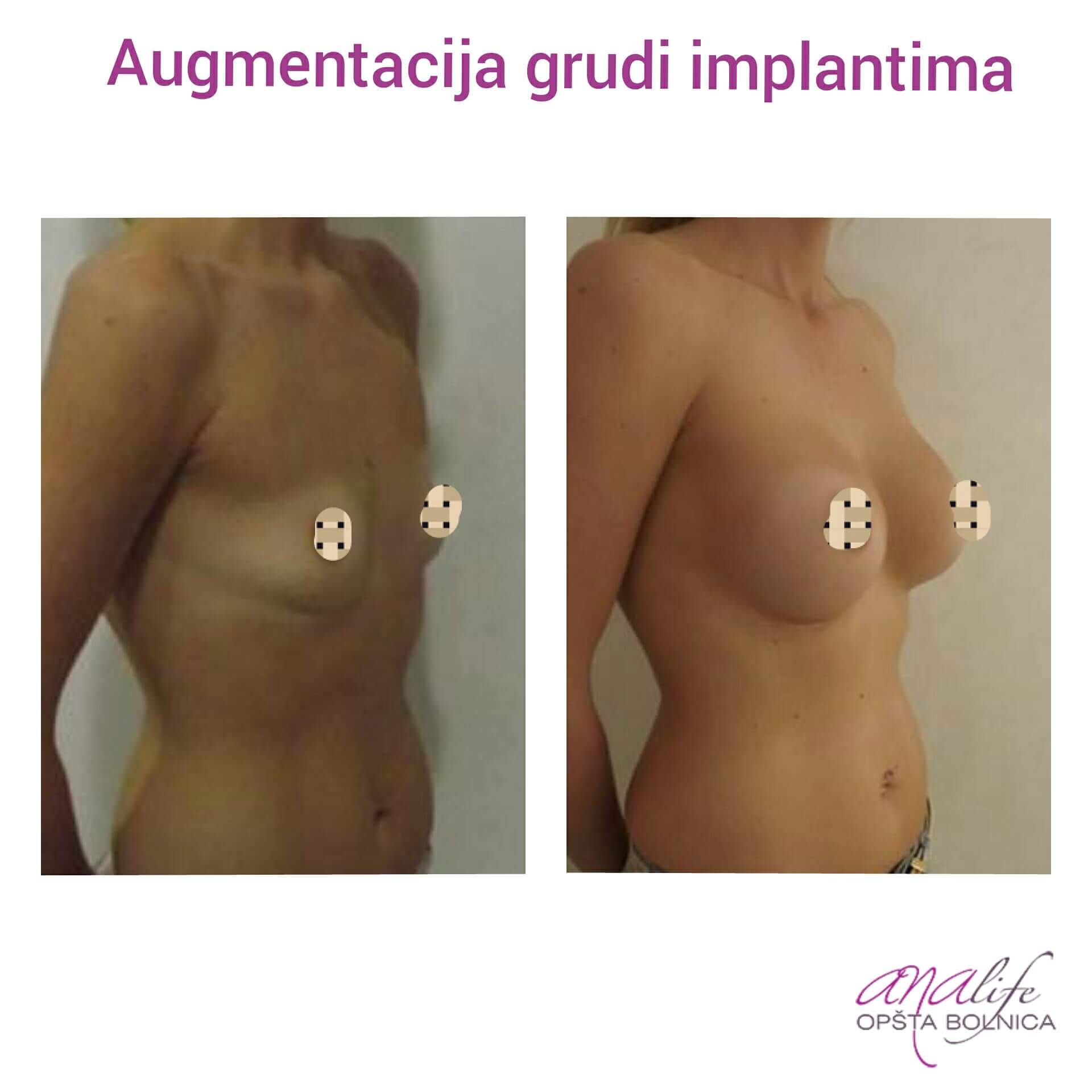 Povećanje grudi (augmentacija) – prirodan volumen i sklad proporcija - slika 68