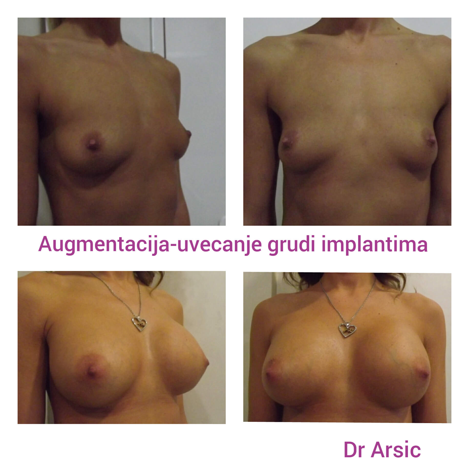 Povećanje grudi (augmentacija) – prirodan volumen i sklad proporcija - slika 71