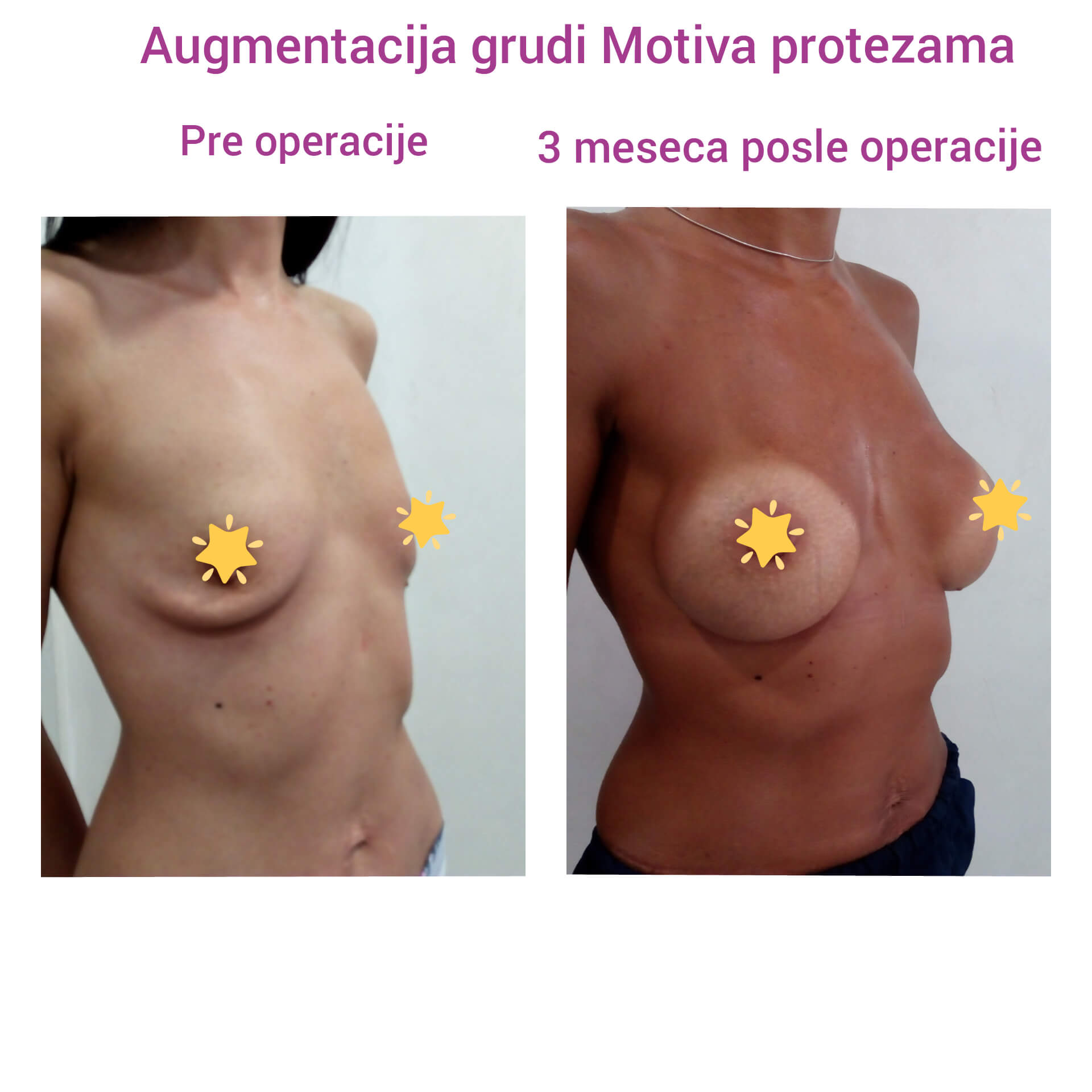 Povećanje grudi (augmentacija) – prirodan volumen i sklad proporcija - slika 72