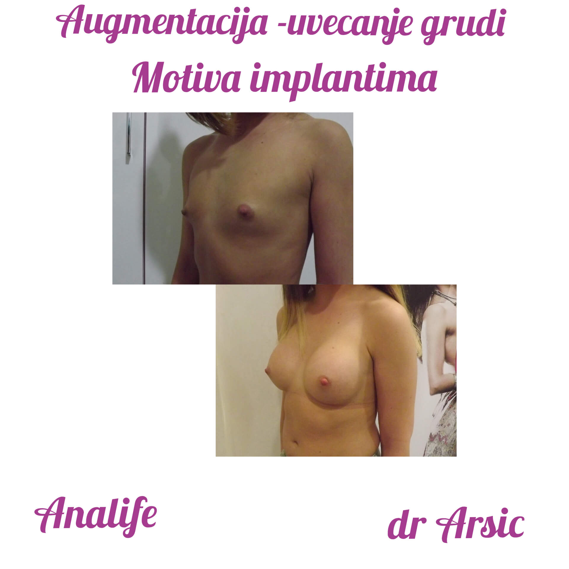 Povećanje grudi (augmentacija) – prirodan volumen i sklad proporcija - slika 76