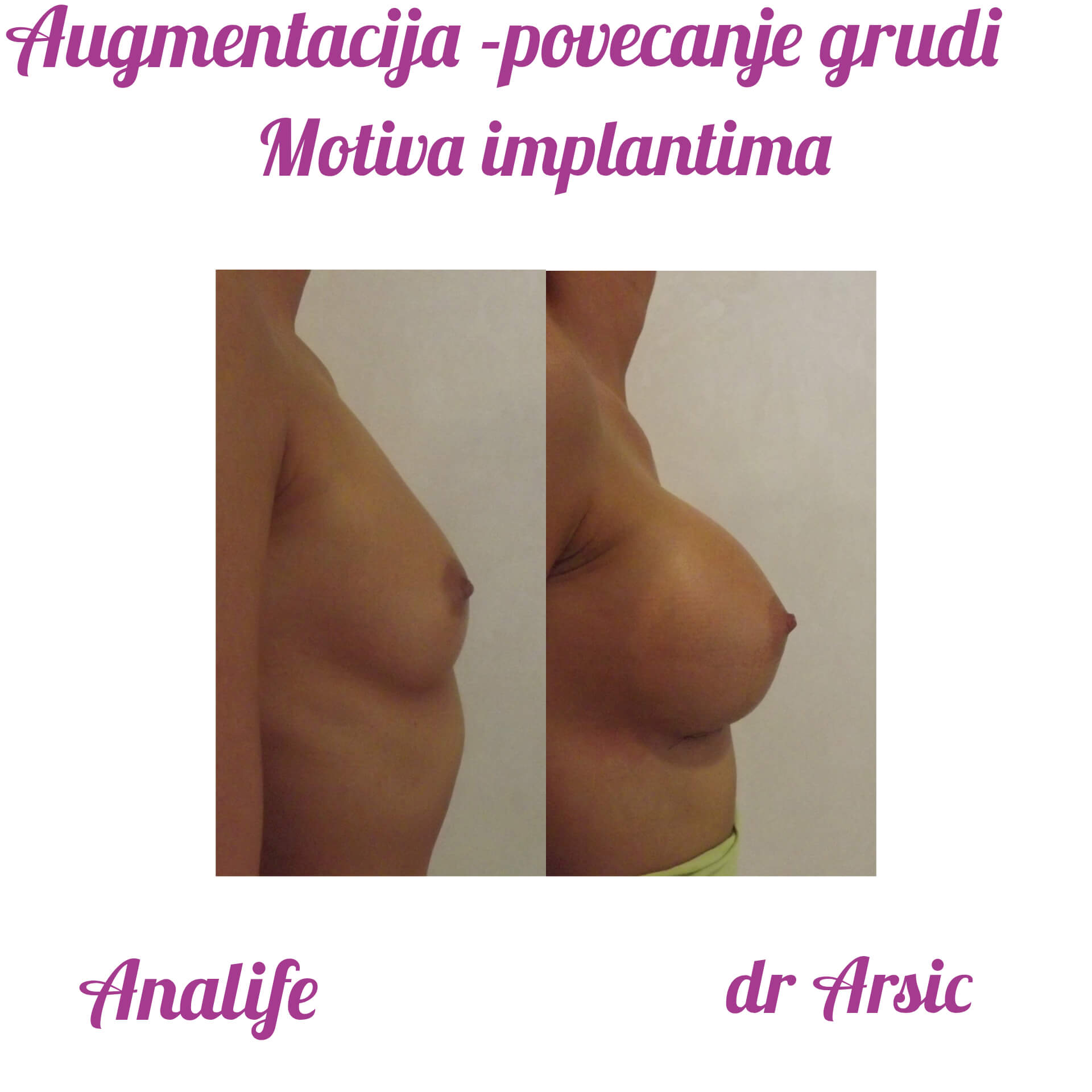 Povećanje grudi (augmentacija) – prirodan volumen i sklad proporcija - slika 77