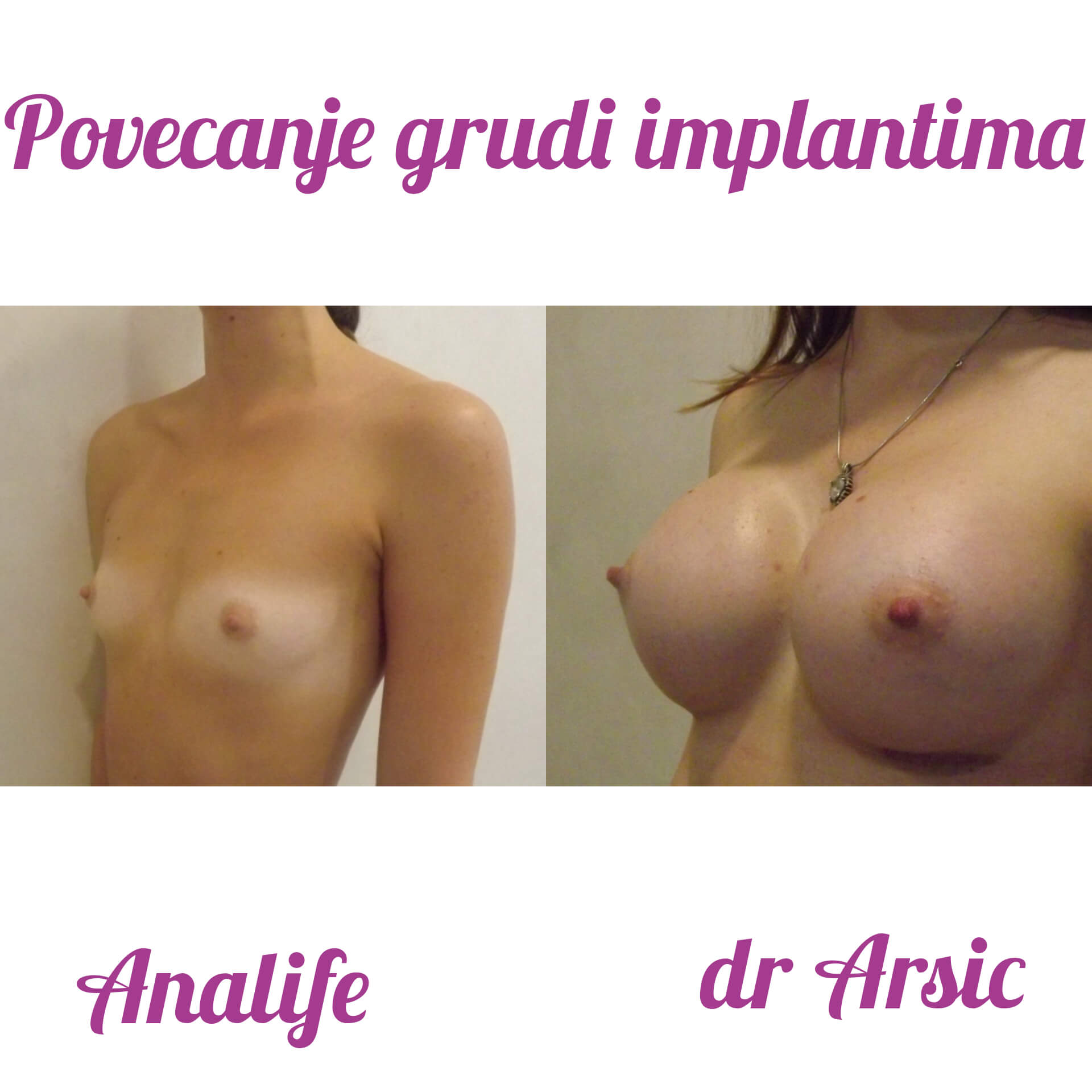 Povećanje grudi (augmentacija) – prirodan volumen i sklad proporcija - slika 78