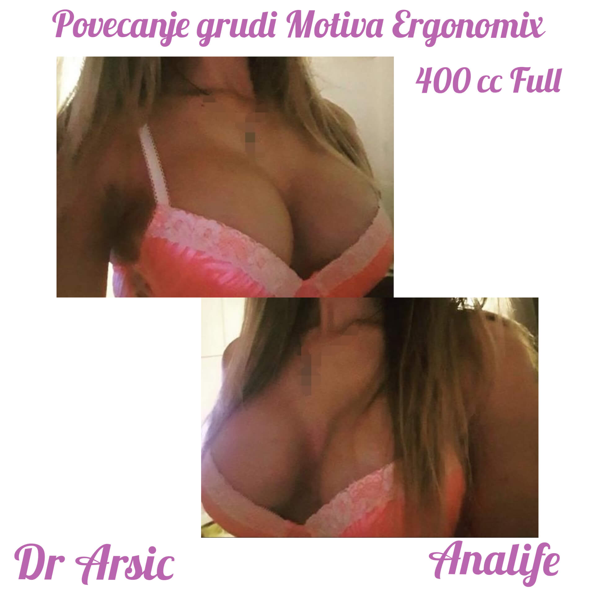 Povećanje grudi (augmentacija) – prirodan volumen i sklad proporcija - slika 80